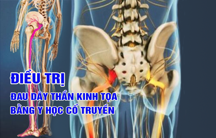 Điều trị bệnh đau thần kinh tọa (yêu cước thống) bằng Y học cổ truyền